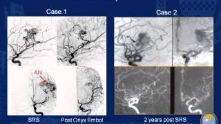 Stereotactic Radiosurgery for Arteriovenous Malformations with Hemorrhage History [upl. by Merla]