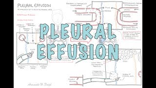 Pleural Effusion DETAILED  pathophysiology signs and symptoms treatment [upl. by Aihpos421]