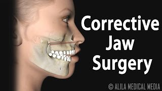 Corrective Jaw Orthognathic Surgery Animation [upl. by Riem]