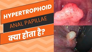 Anal Papillae क्या होता हैhypertrophoid papillae fissure chronic piles symptoms fistula [upl. by Derick787]