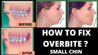 HOW TO FIX OVERBITE amp Small chin  WITH NO BRACES [upl. by Atikan656]