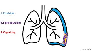 Empyema and Pleural Effusions [upl. by Aynot]